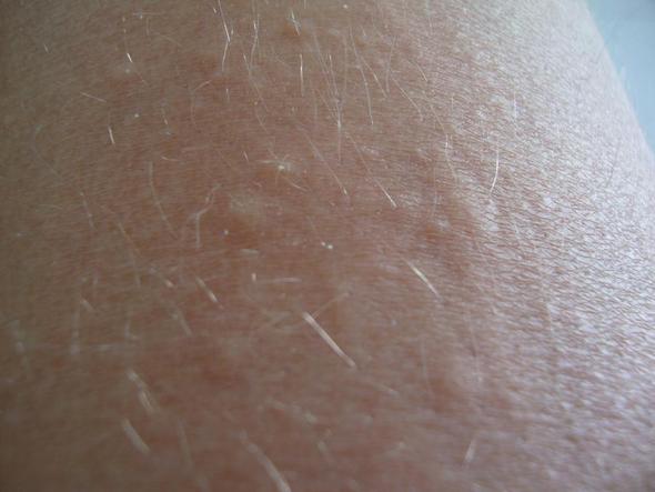 Komische Kleine Pickelchen Was Konnnte Das Sein Pickel Juckreiz