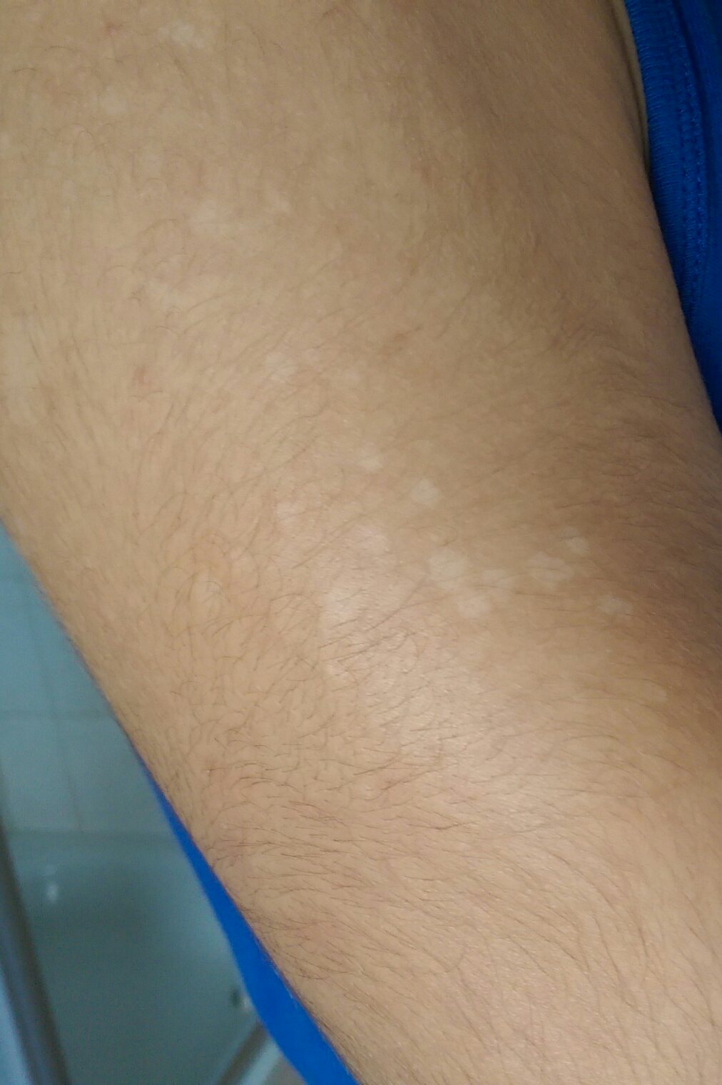 Komische Kleine Weisse Flecken Auf Der Haut Hilfe Gesundheit Arzt Komische Kleine Weisse Flecken Auf Der Haut Hilfe Gesundheit Arzt