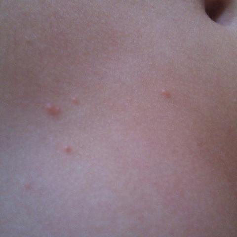 Komische Pickel Am Bauch Komische Pickel Am Bauch