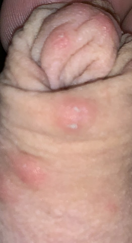 Im intimbereich pickel kleine Pickel im