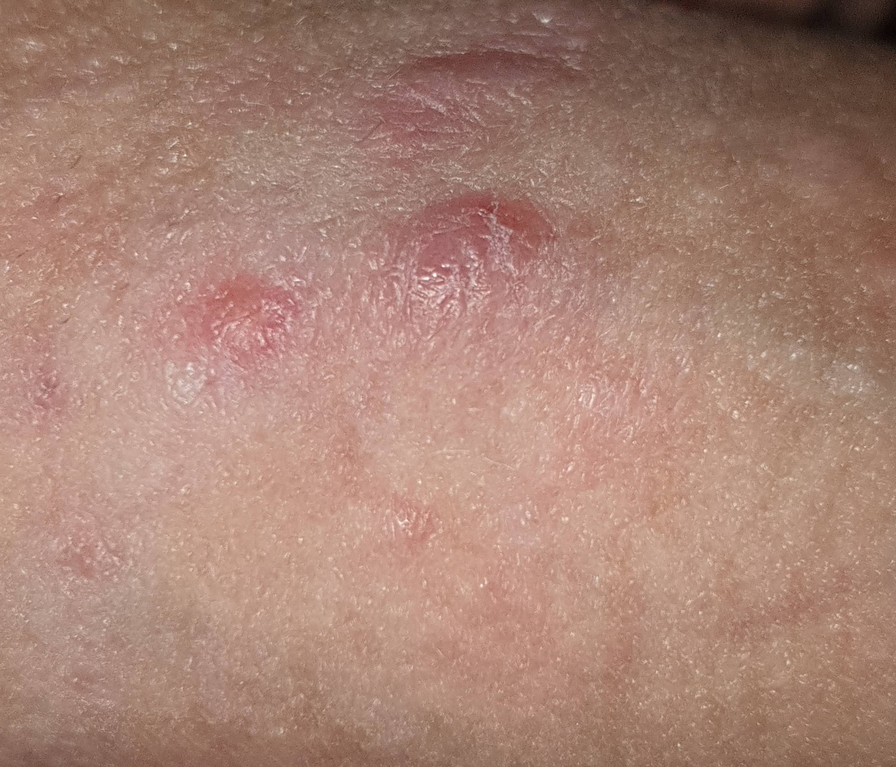 Vorhaut weiße punkte Weiße Punkte