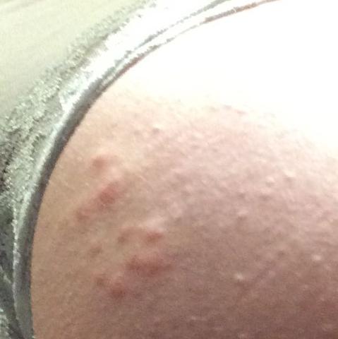 Komische Pickel Am Po Von Heut Auf Morgen Gesundheit Arzt Beauty Komische Pickel Am Po Von Heut Auf Morgen Gesundheit Arzt Beauty