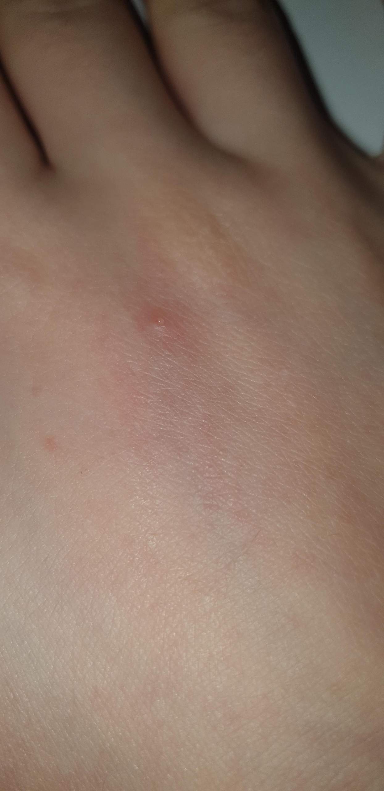 Komische Pickel an der Hand? (Gesundheit, Medizin) pickel hand