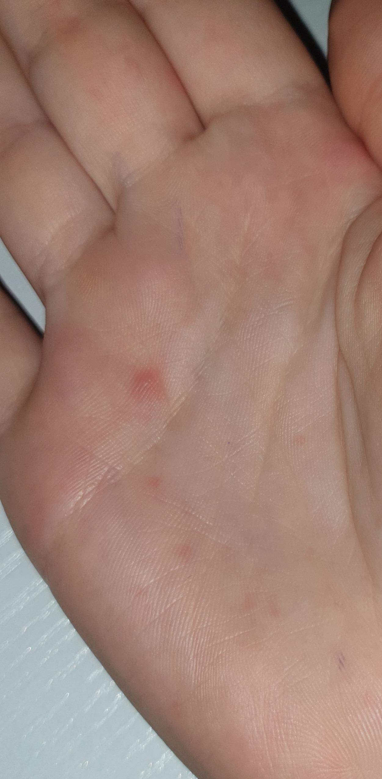 Komische Pickel an der Hand? (Gesundheit, Medizin) pickel an hand