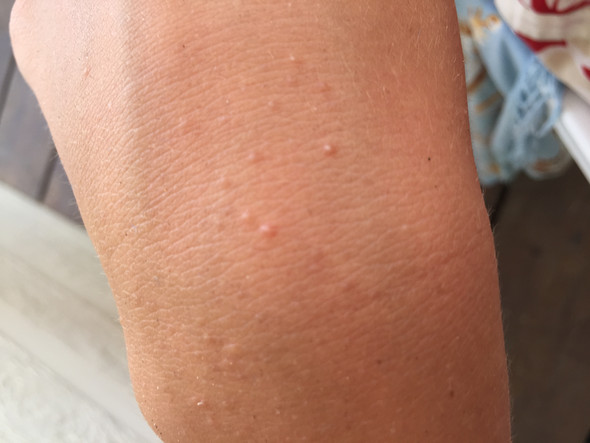 Komische Pickel An Der Hand Komische Pickel An Der Hand