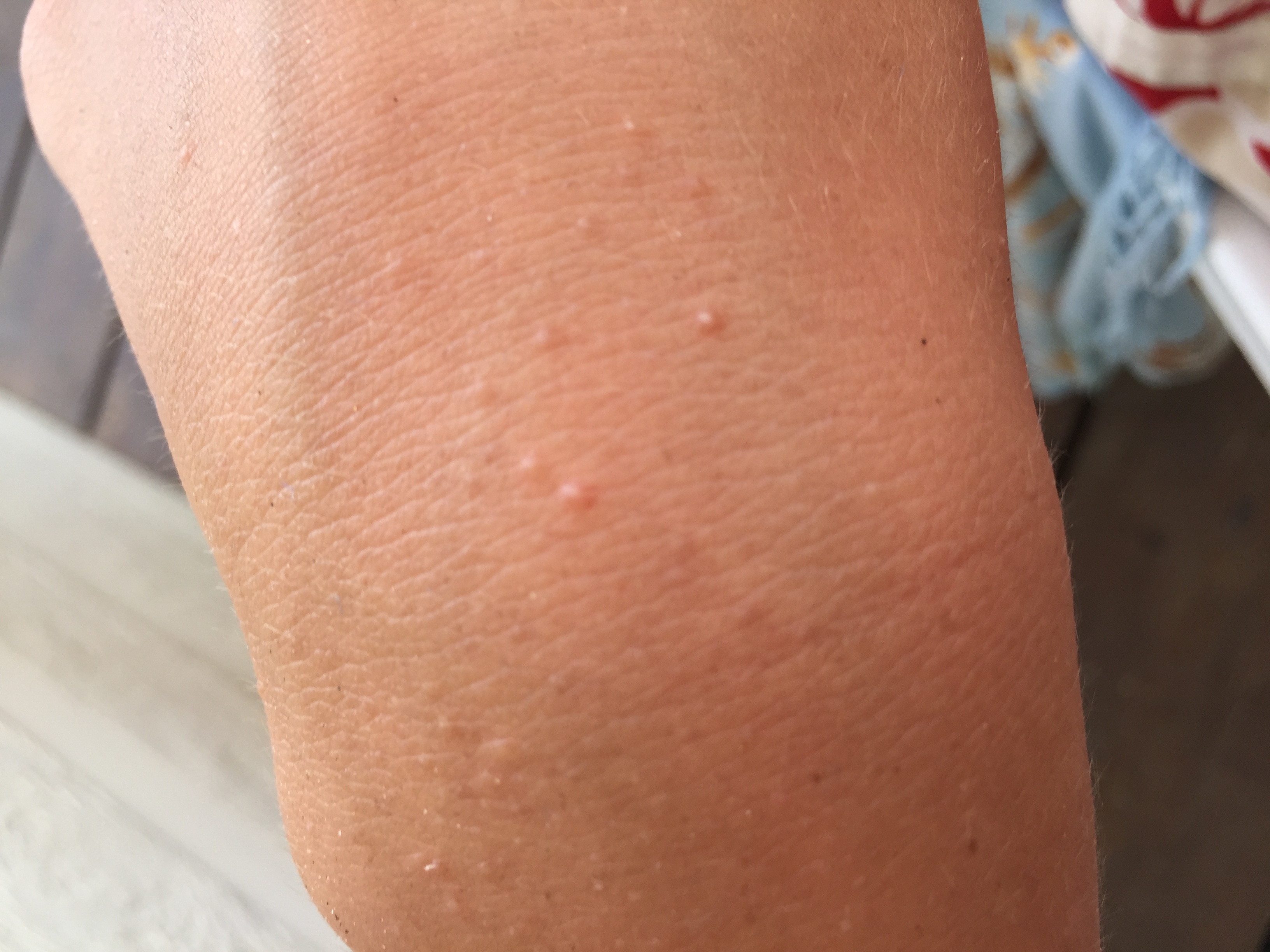 Komische Pickel an der Hand? pickel an der wirbelsäule