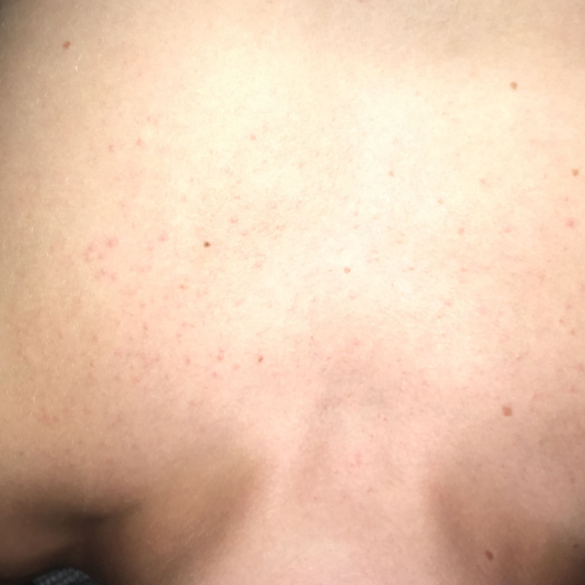 Komische Pickel auf der brust? (Gesundheit und Medizin, Blasen) Komische Pickel auf der brust? (Gesundheit und Medizin, Blasen)