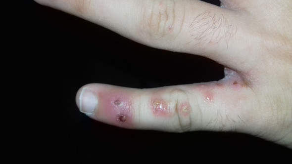 Komische Pickel Auf Der Hand Komische Pickel Auf Der Hand