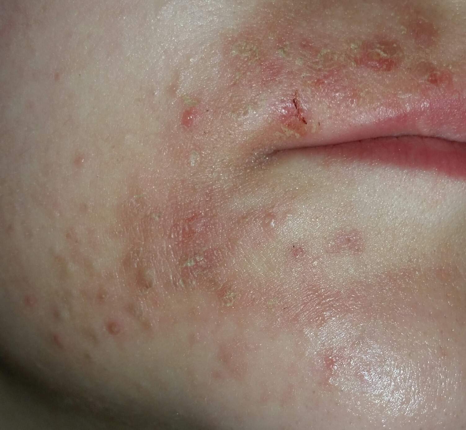 pickel bei kindern 9 jahre pickel bei kindern 9 jahre