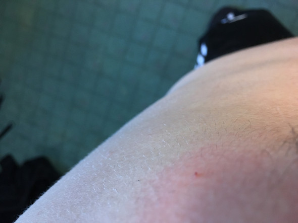 Komische Pickel Uber Der Brust Gesundheit Haut Knotchen Komische Pickel Uber Der Brust Gesundheit Haut Knotchen