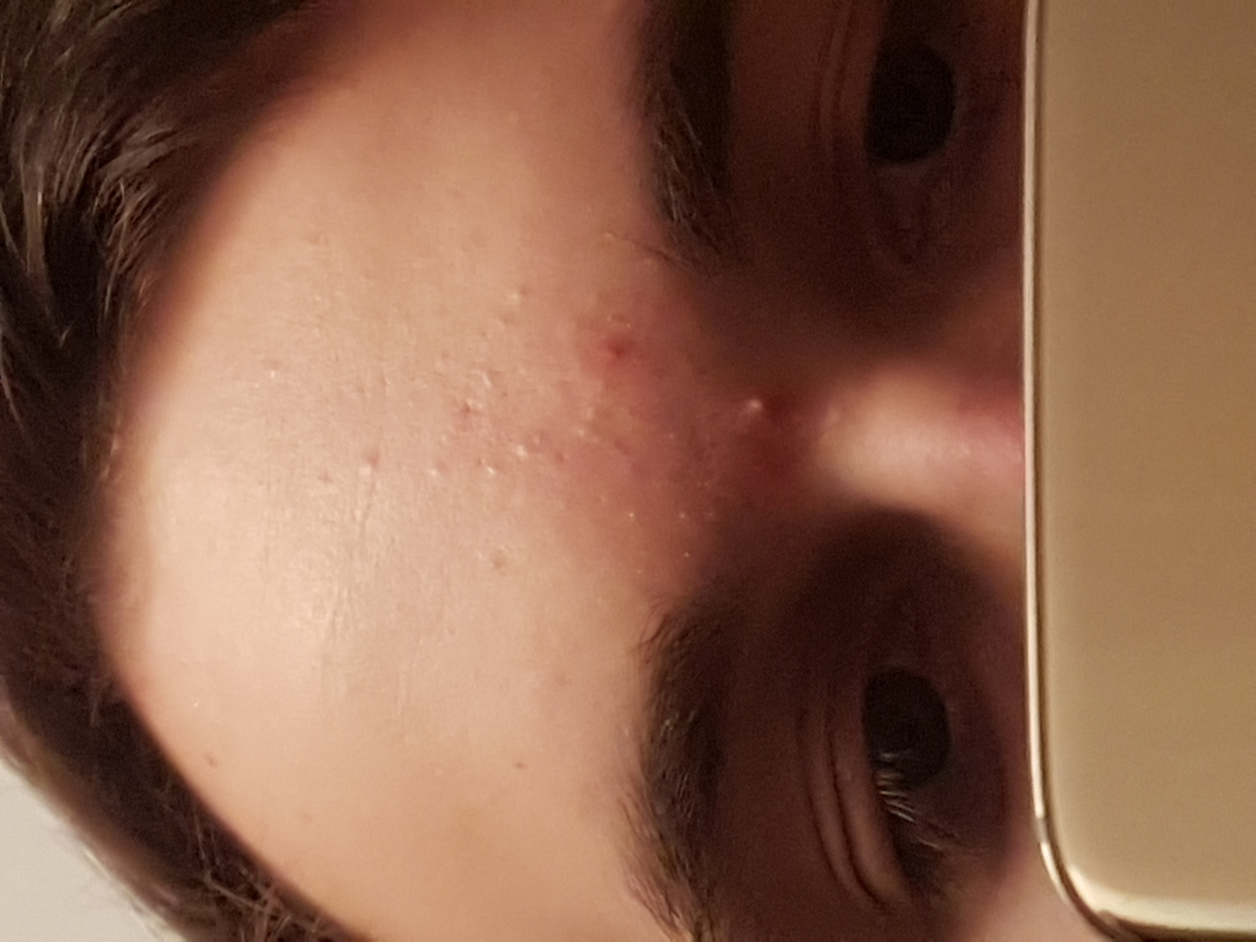 Komische pickel Zwischen den Augenbrauen seit 2 Jahren !? Woran liegt es ? (Akne) pickel kiefer