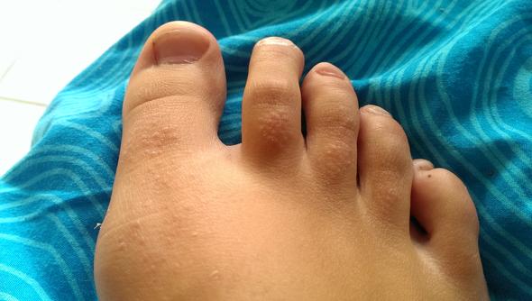 Der schlimmere Fuß - (Körper, Haut, Pickel)