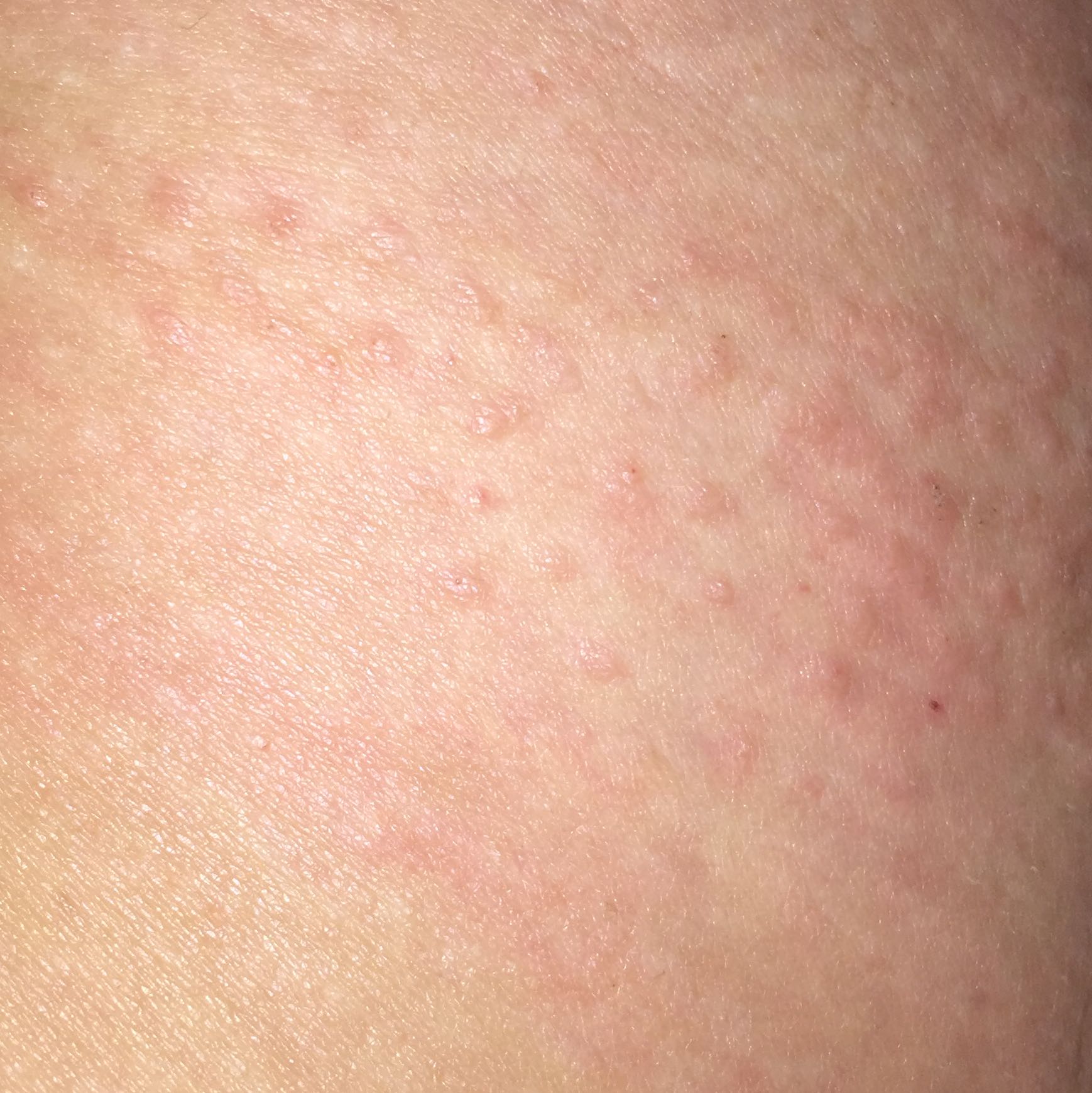 Komische pickelchen auf der Haut? (Pickel)