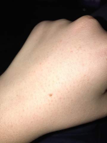 Komische Punkte Auf Dem Handrucken Was Tun Gesundheit Und Medizin Gesundheit Arztbesuch Komische Punkte Auf Dem Handrucken Was Tun Gesundheit Und Medizin Gesundheit Arztbesuch