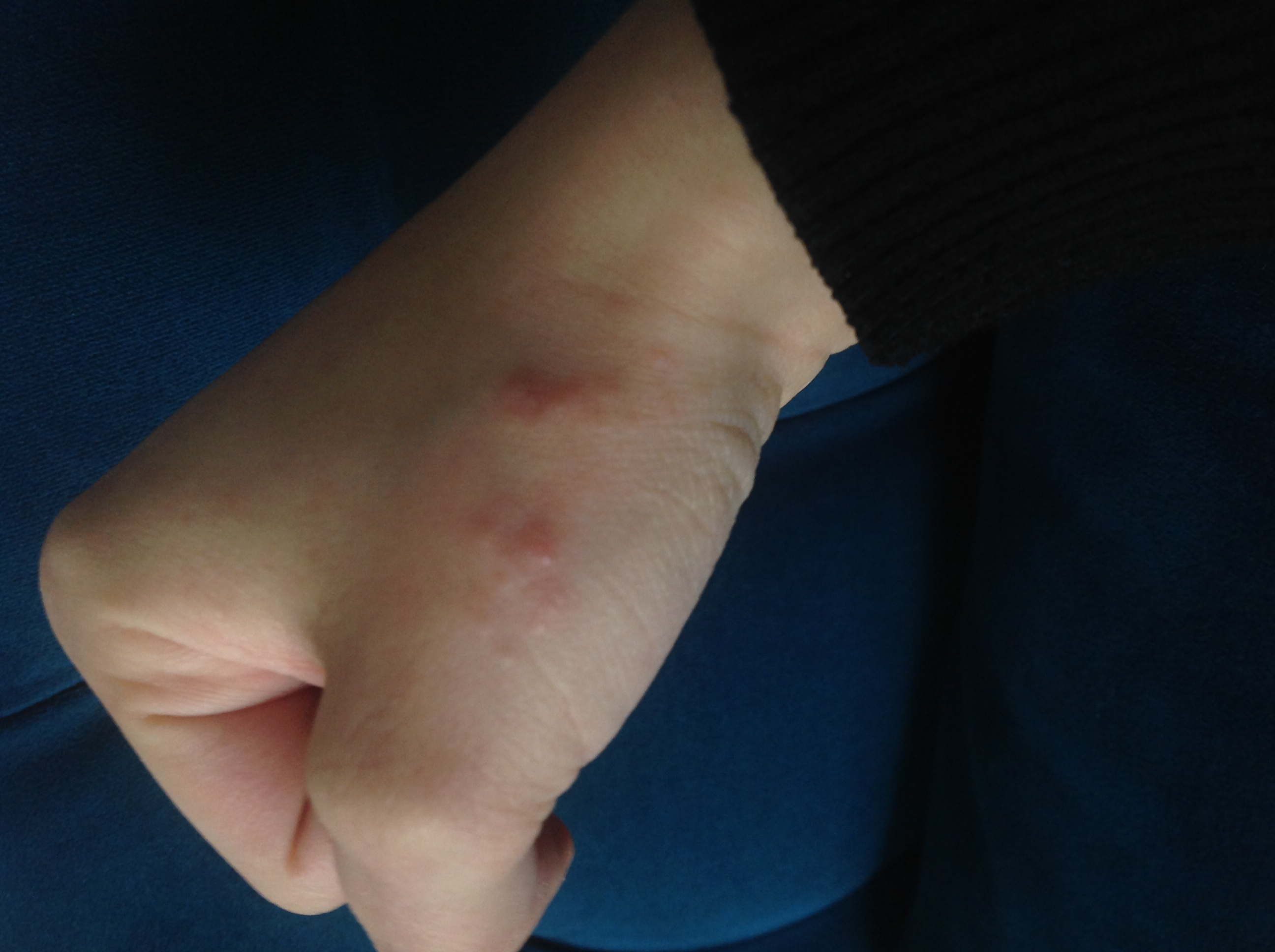 Komische Punkte auf der Hand? (Ausschlag) Komische Punkte auf der Hand? (Ausschlag)