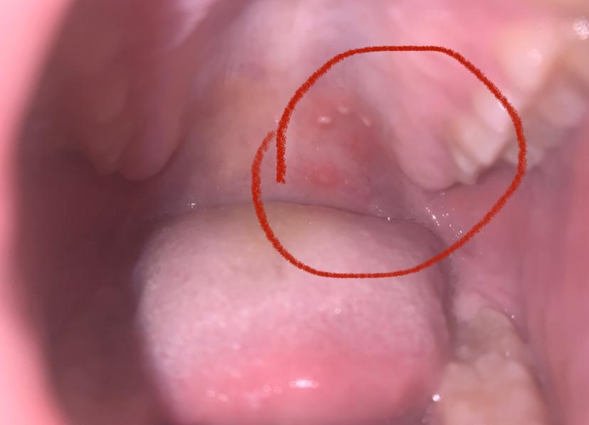 Komische Punkte Im Rachen Gesundheit Und Medizin Mundgeruch Komische Punkte Im Rachen Gesundheit Und Medizin Mundgeruch