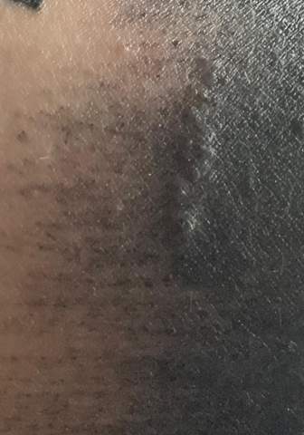 Komische Pusteln Auf Abgeheiltem Tattoo Gesundheit Und Medizin Haut Creme