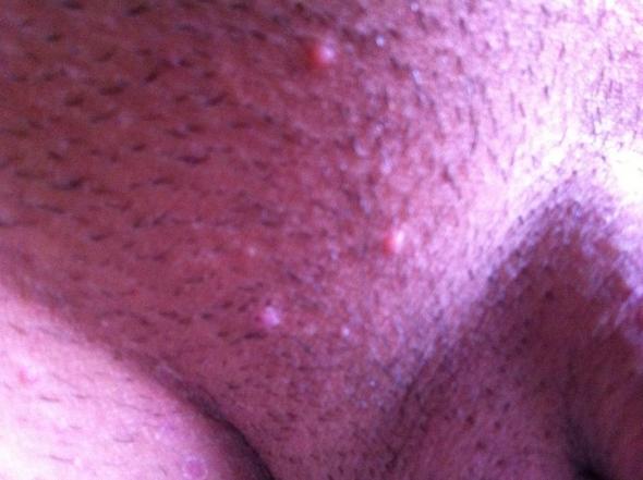 Komische Rot Weisse Pickelchen Im Intimbereich Hautarzt