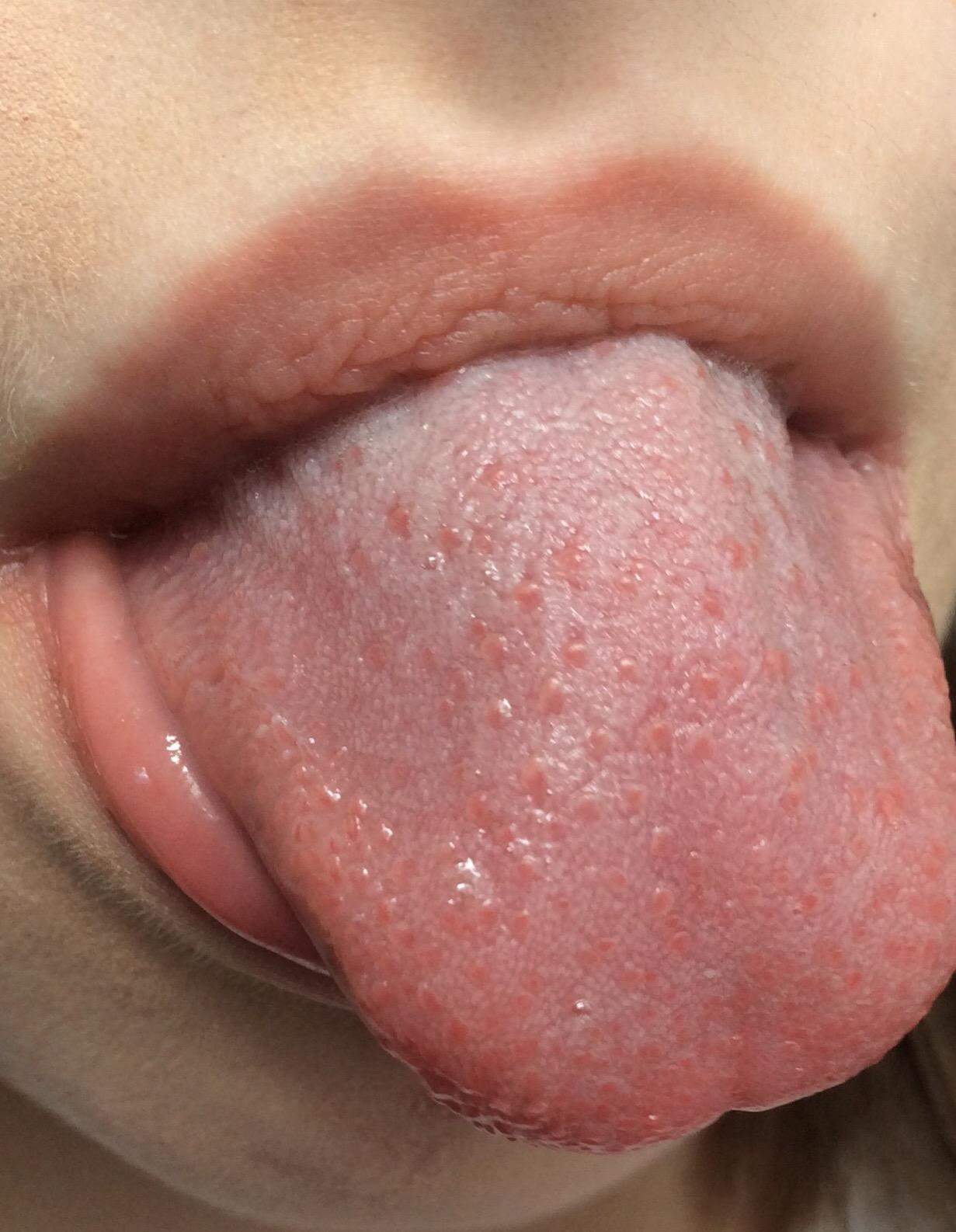 Komische Rote Dinger Auf Zunge Pickel Herpes Feigwarzen Siehe Bild Gesundheit Und Medizin Gesundheit Beauty Komische Rote Dinger Auf Zunge Pickel Herpes Feigwarzen Siehe Bild Gesundheit Und Medizin Gesundheit Beauty