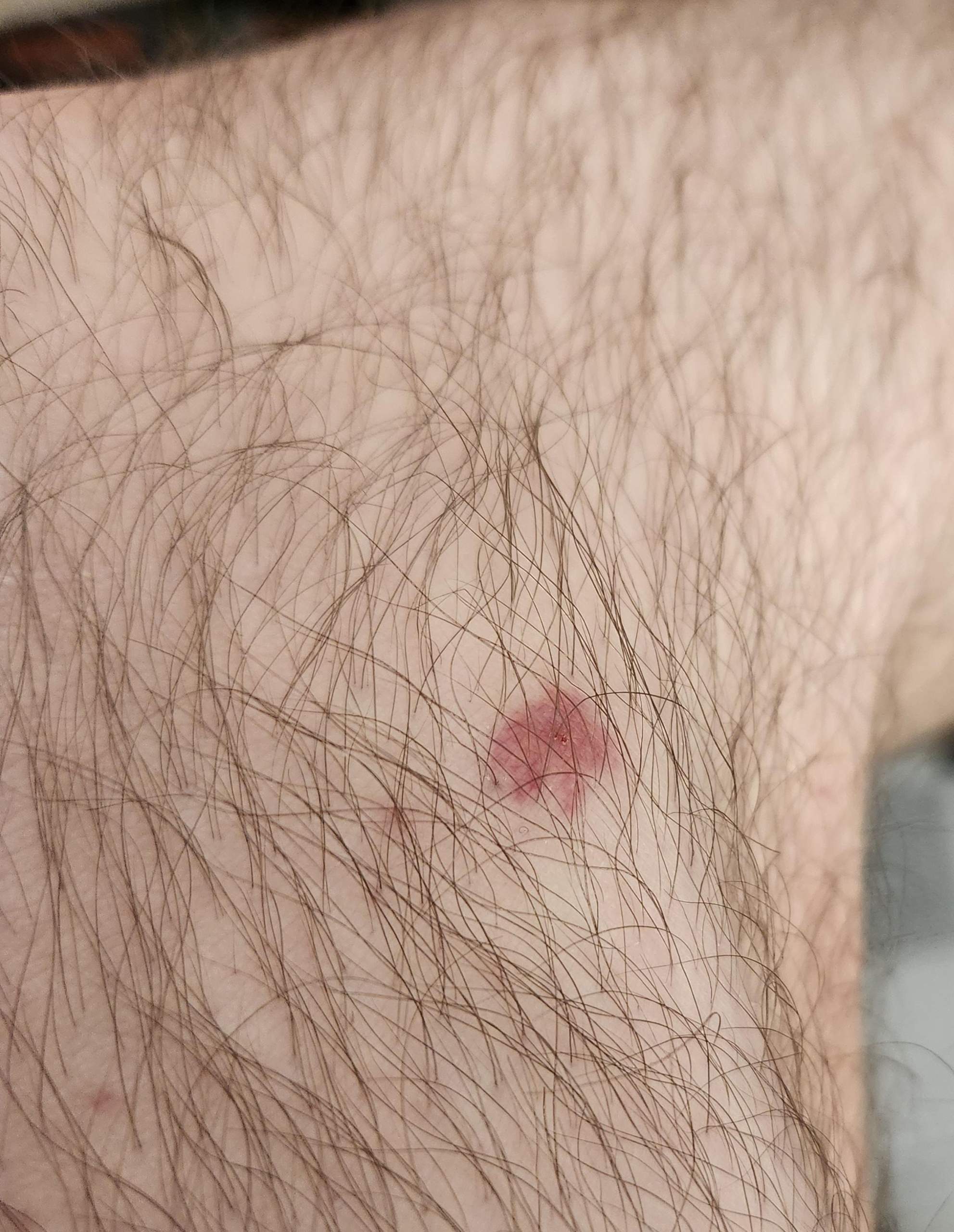 komische-rote-flecken-am-bein-haut-r-tung
