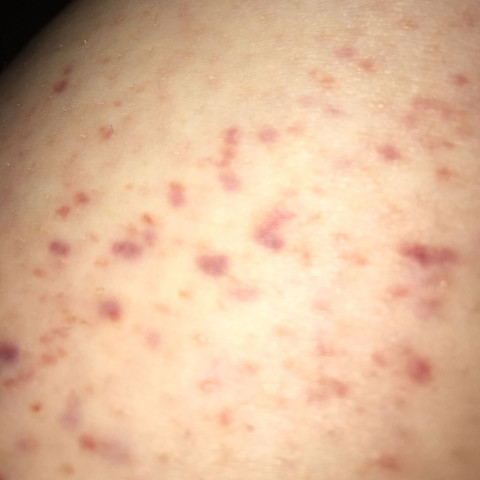 Bild 2  - (Krankheit, Haut, Allergie)