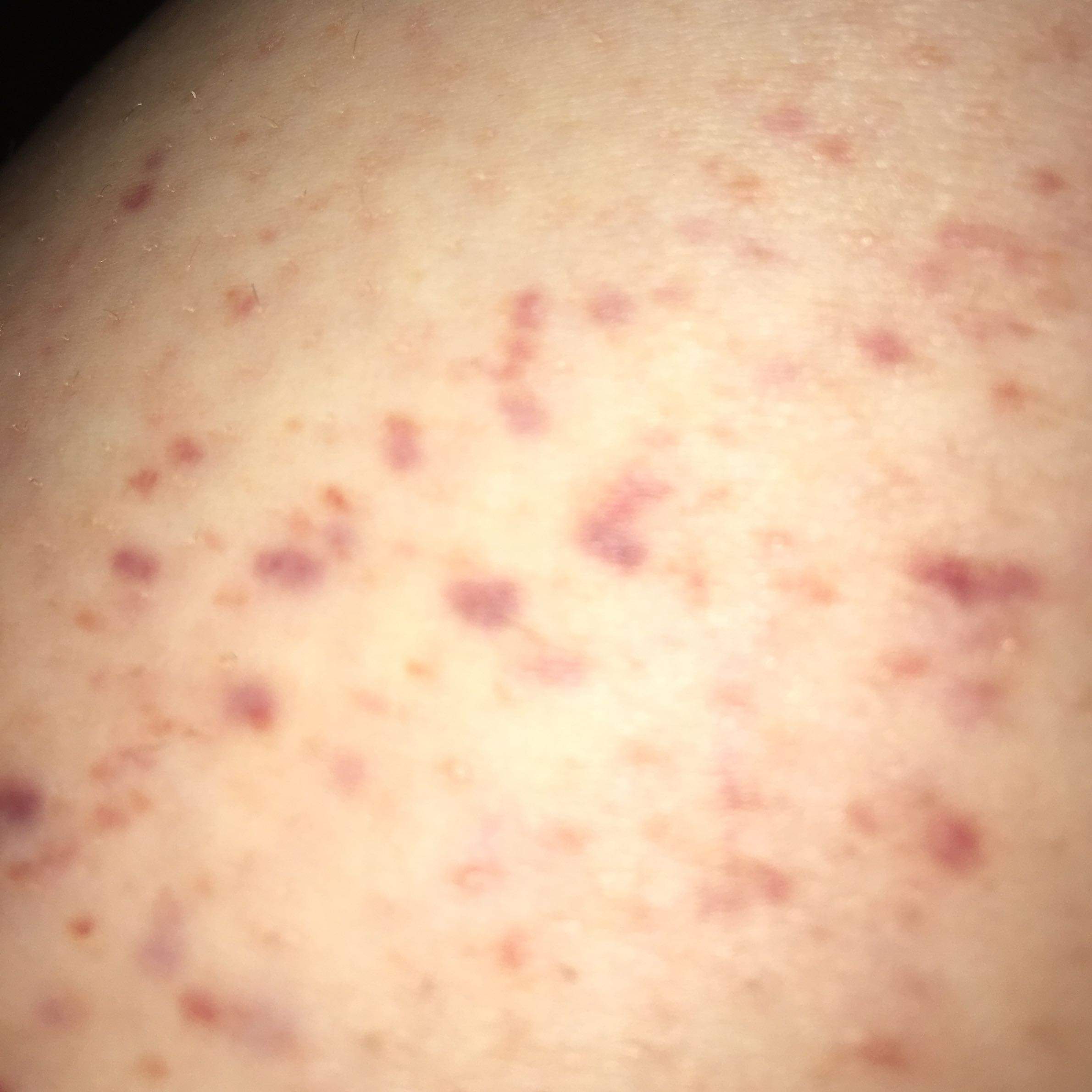 Komische rote Flecken am Oberschenkel? (Krankheit, Haut, Allergie)