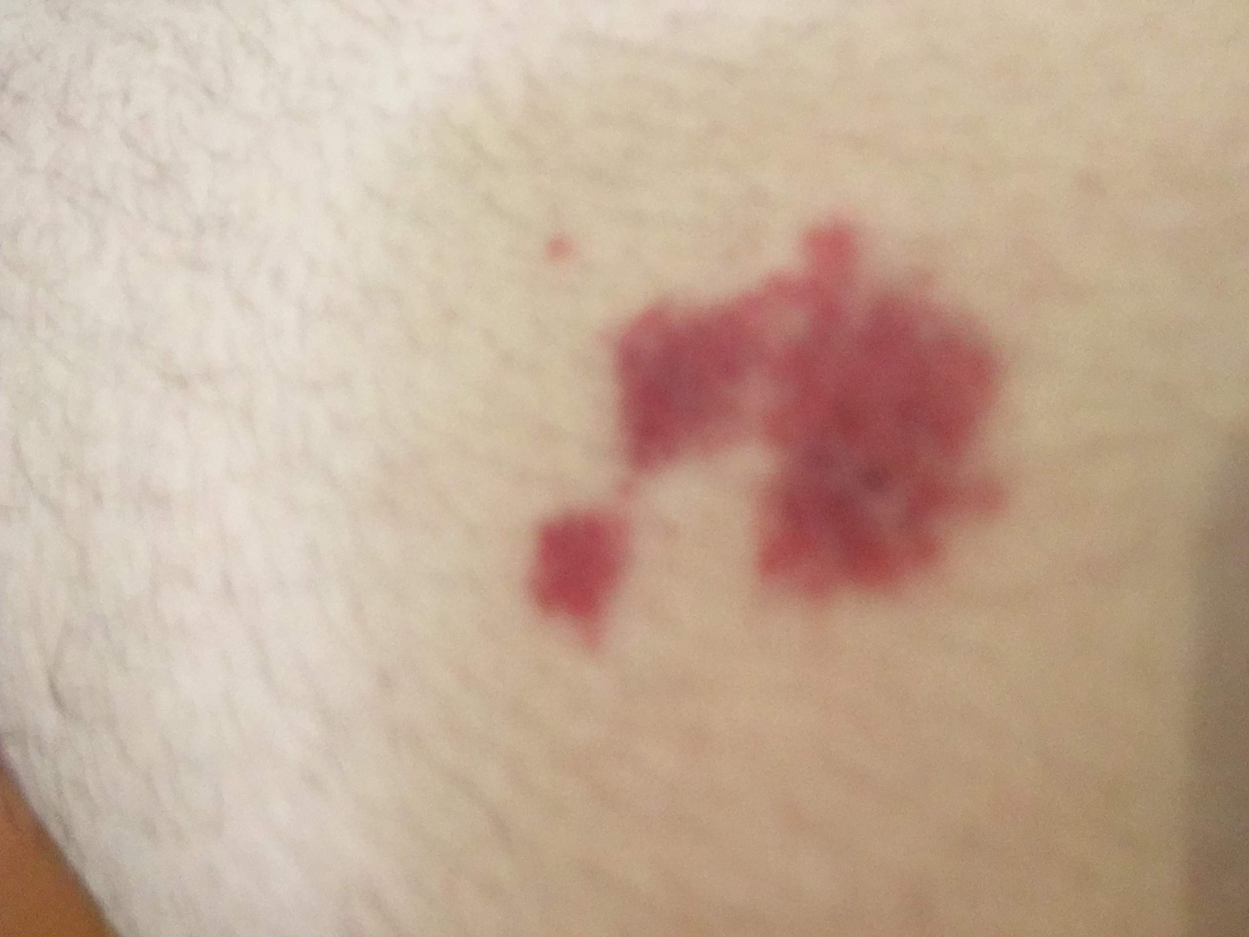 Komische Rote Flecken An Meinem Bein Beine Komische Rote Flecken An Meinem Bein Beine