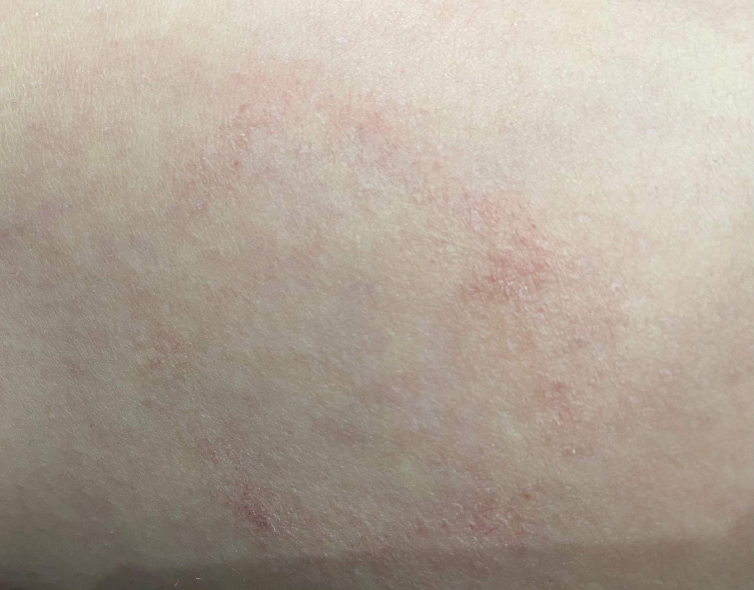 Rote Kreis Auf Der Haut www.gesundheitsfrage.net
