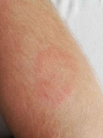 Komische Rote Kreise Auf Unter Der Haut Was Kann Das Sein Gesundheit Medizin Krankheit Komische Rote Kreise Auf Unter Der Haut Was Kann Das Sein Gesundheit Medizin Krankheit