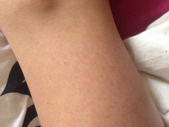 Komische Rote Punkte An Beinen Haut Beine Rasieren