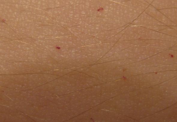 Ich Habe Komische Rote Punkte Auf Der Haut Was Kann Das Sein Gesundheit Hautausschlag Hautrotung Ich Habe Komische Rote Punkte Auf Der Haut Was Kann Das Sein Gesundheit Hautausschlag Hautrotung
