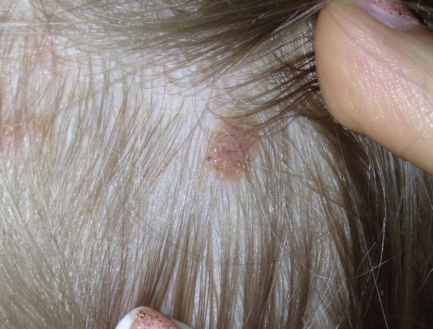 Beulen Am Hinterkopf Beulen Am Hinterkopf