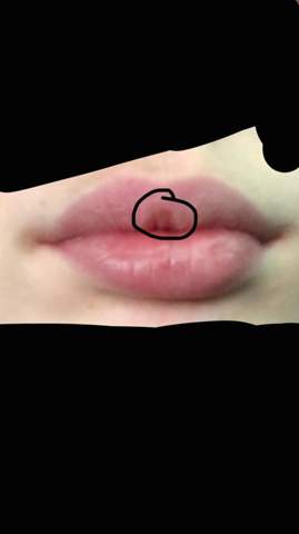 Lippe gegen an der was tun knutschfleck Knutschfleck entfernen