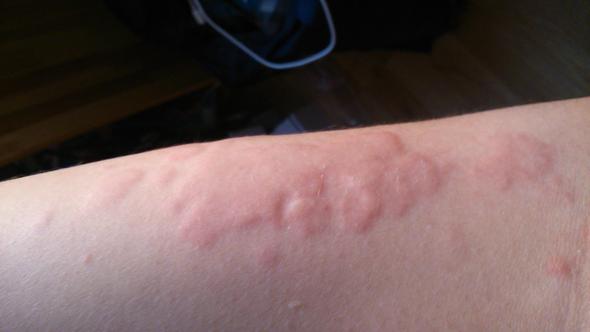 Komische Stiche Am Arm Gesundheit Insektenstich Komische Stiche Am Arm Gesundheit Insektenstich