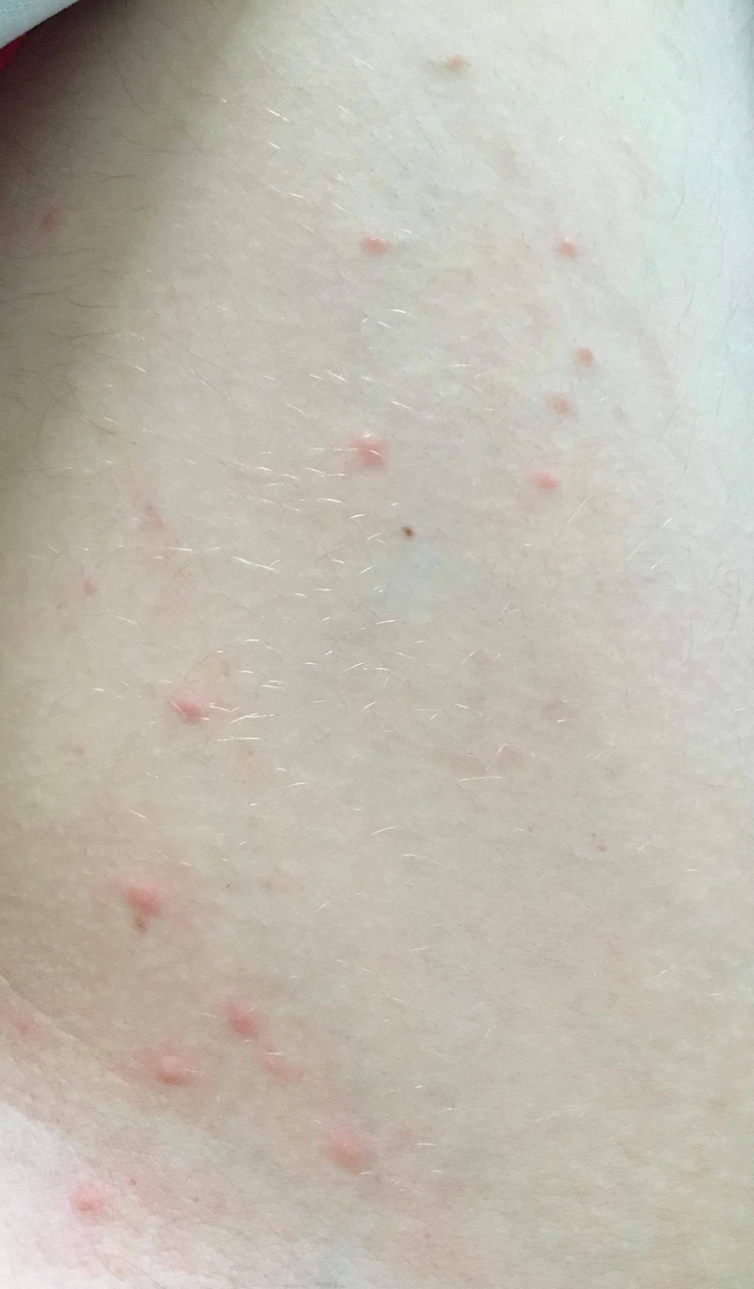 Komische Stiche Oder Ausschlag Auf Meinem Krper? (Gesundheit Und