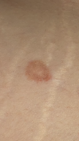 Komische Trockene Rote Flecken Auf Der Haut Was Kann Das Sein Korper Hautpflege Rot Komische Trockene Rote Flecken Auf Der Haut Was Kann Das Sein Korper Hautpflege Rot