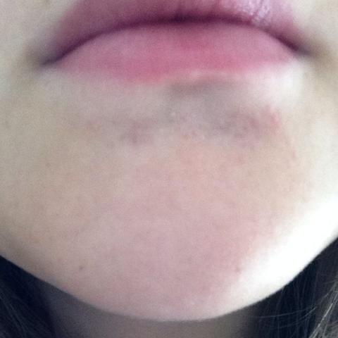 Komische Violette Punkte Was Ist Das Haut Lippe