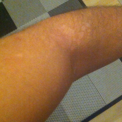 Komische Weisse Flecken Auf Der Haut Mit Bild Komische Weisse Flecken Auf Der Haut Mit Bild