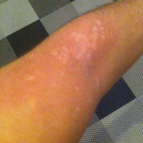 Komische Weisse Flecken Auf Der Haut Mit Bild Komische Weisse Flecken Auf Der Haut Mit Bild