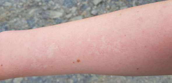 Komische weiße Flecken auf Haut? (Gesundheit und Medizin, Gesundheit, Sport)