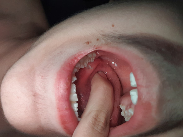 Komische Wunde An Der Zunge Schmerzen Komische Wunde An Der Zunge Schmerzen