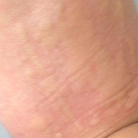 Arm noch stärker abgewinkelt - (Arzt, Krankheit, Ausschlag)