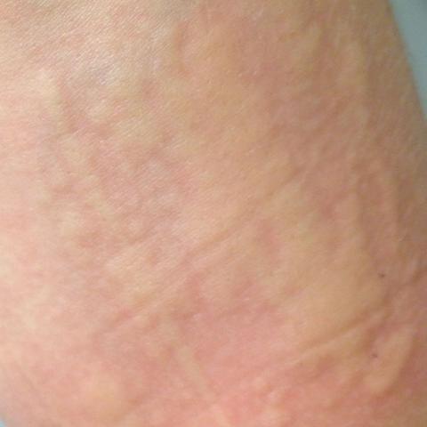 Arm angewinkelt - (Arzt, Krankheit, Ausschlag)
