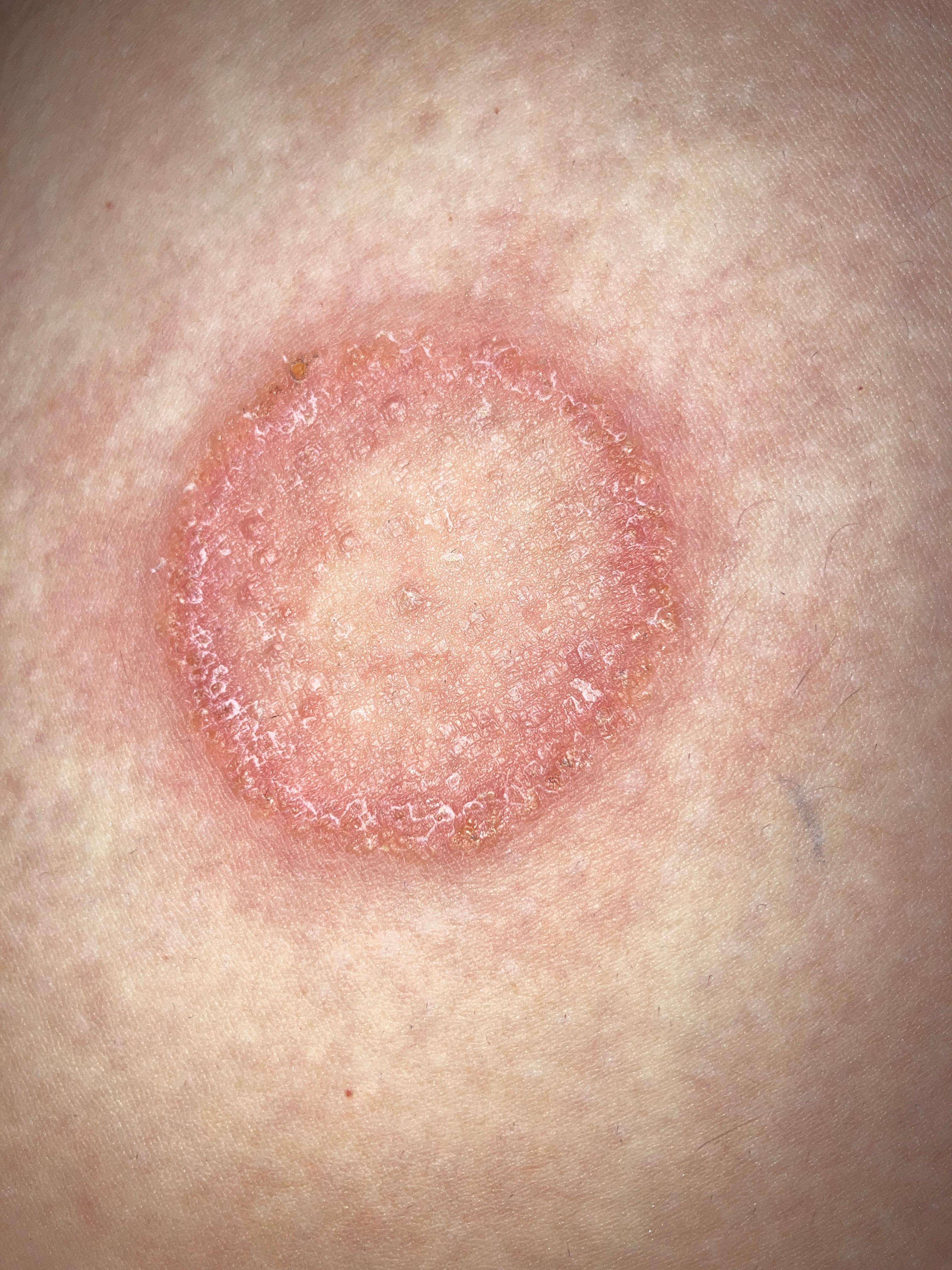 Komischer ausschlag am Oberschenkel was tun? (Gesundheit und Medizin
