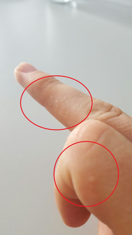 Finger - (Finger, Ausschlag)