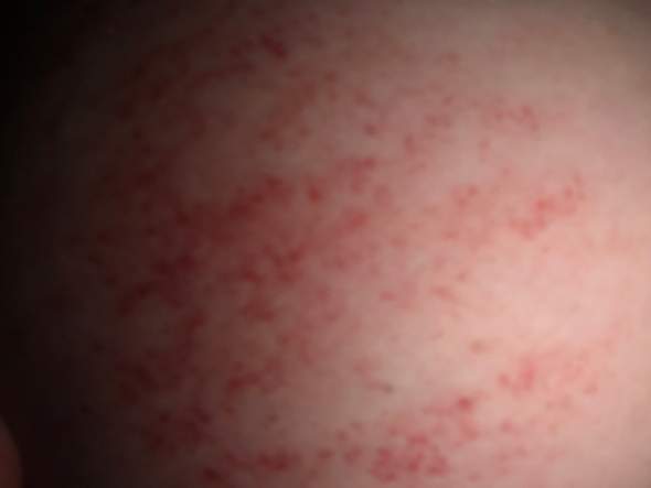 Komischer Ausschlag unter der Brust? (Gesundheit und Medizin