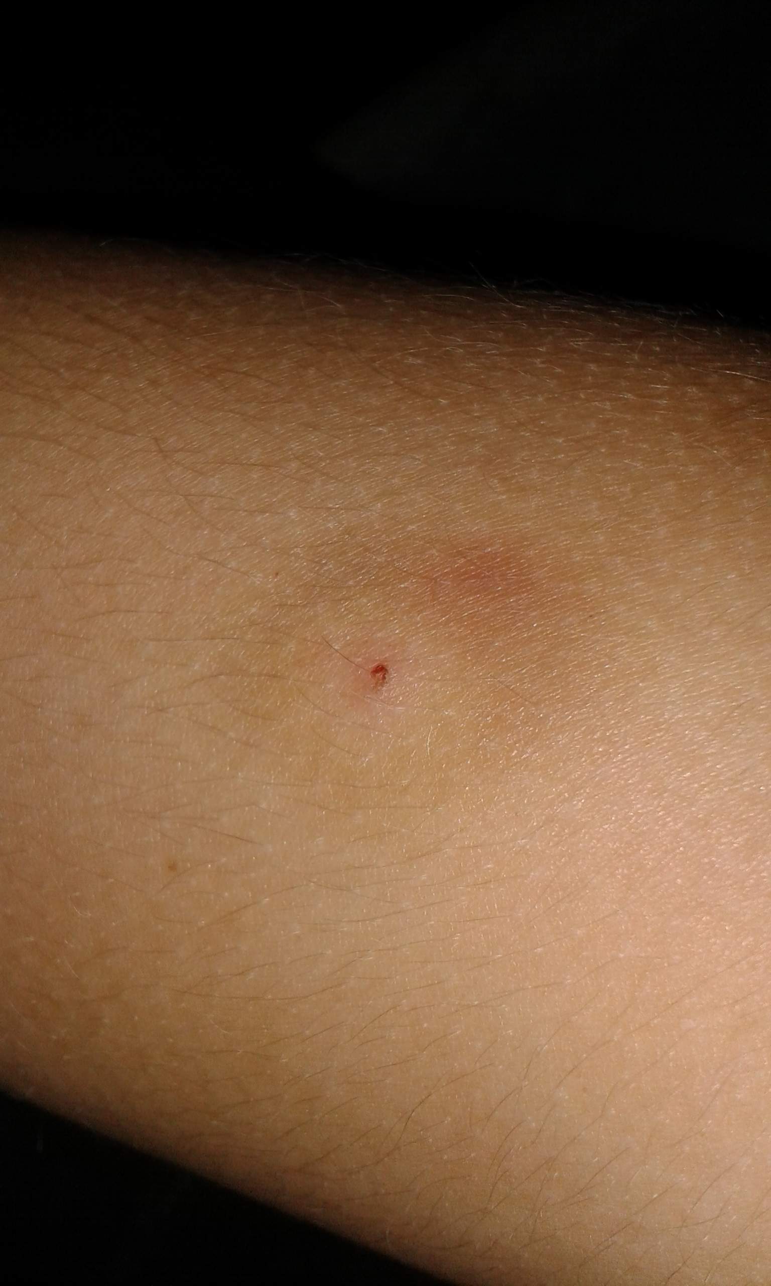 Komischer blauer fleck um kleinen biss, muss ich zum Arzt oder ist das harmlos?sieht man auf dem