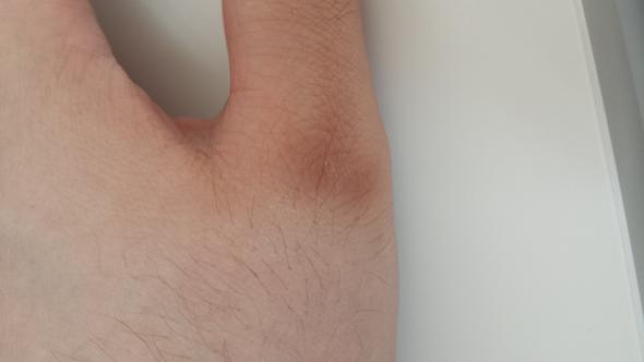 Komischer Brauner Fleck An Der Hand Gesundheit Hautpflege