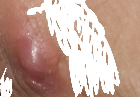 Komischer Dicker Knubbel Unter Der Haut Pickel Blut Komischer Dicker Knubbel Unter Der Haut Pickel Blut