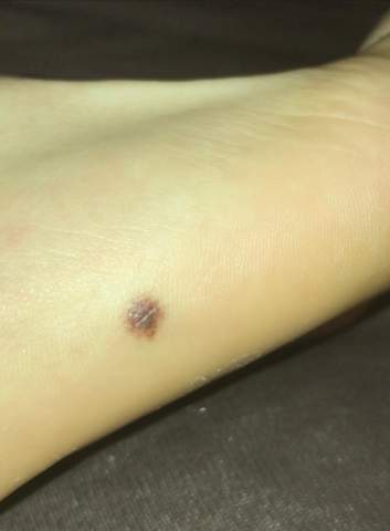 Fußsohle muttermal Hautkrebsvorsorge: Gefahr